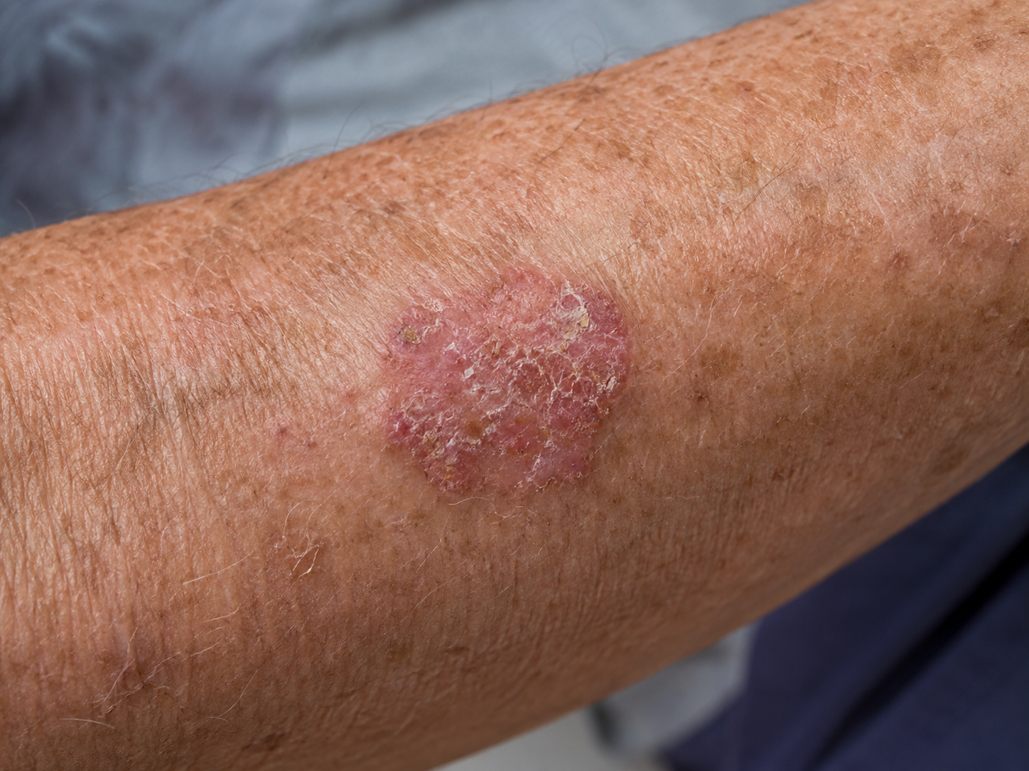 Close-up of a skin cancer lesion on an arm.